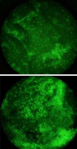 De grønne flekkene på bildene er cellekjerner behandlet med fluorescerende fargestoff. Cellene er hentet fra munnhulen til kreftpasienter. 
I det friske vevet (øverst) er kjernene små og har stor avstand til hverandre. Kreftcellene (nederst) er unormalt store, og har kort avstand til hverandre.
(FOTO: D. Shin/Rice University)