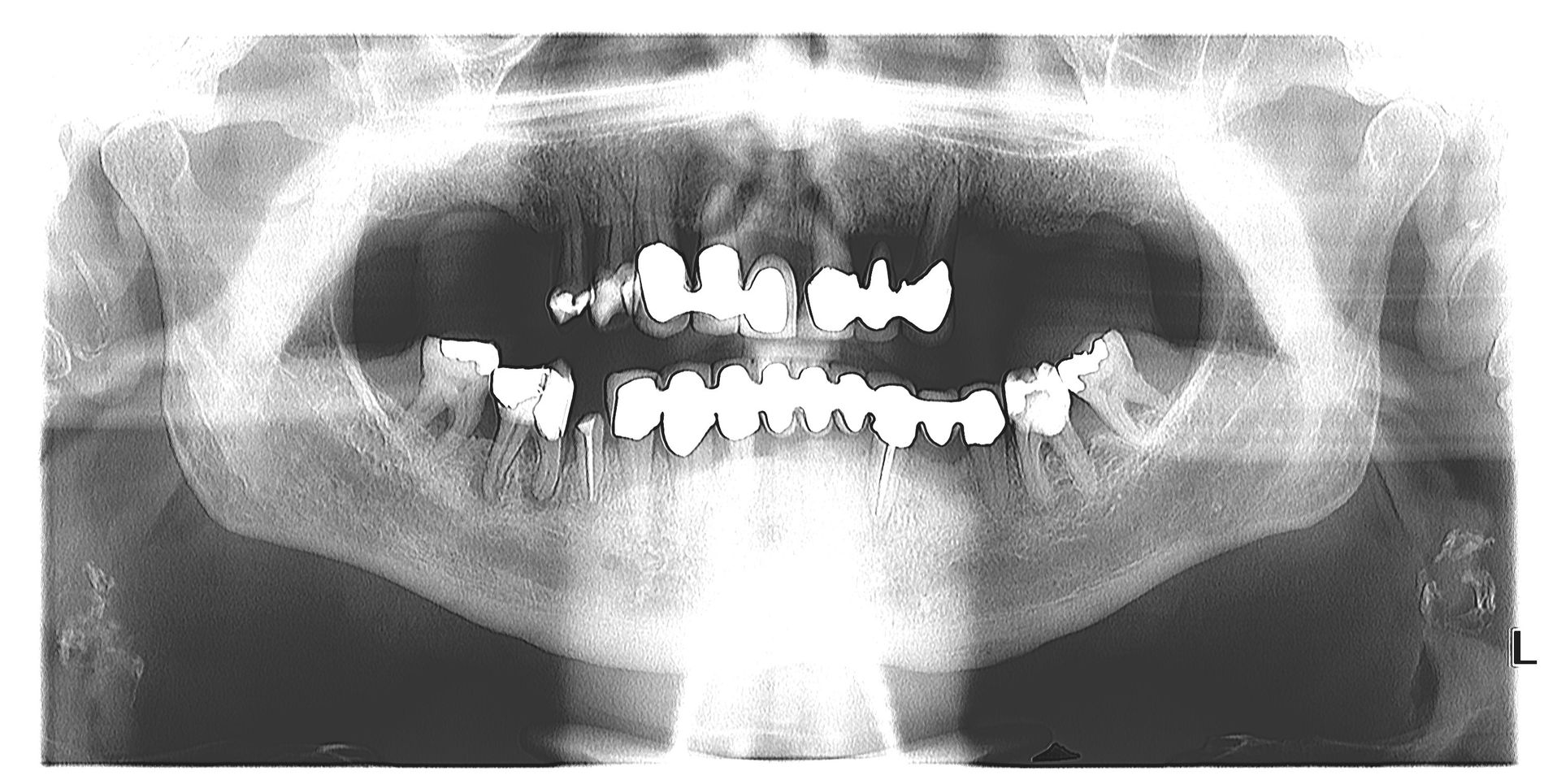 VENTET FOR LENGE : Etter flere år med tannkjøttsykdommen periodontitt, hadde Kenneth (71) mistet flere tenner i overkjeven. Slik så røntgenbildet ut før behandlingen hos Eurodents klinikk i Budapest. FOTO: Eurodent 