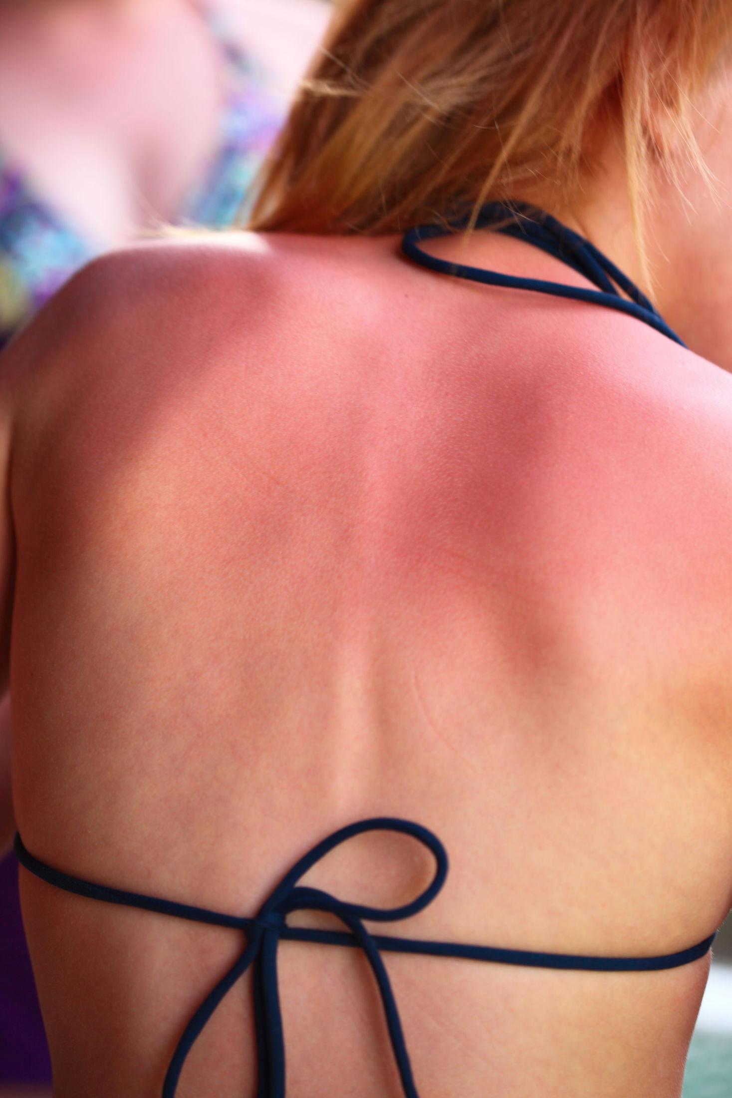 SOLBRENT: Gå i skyggen om ryggen din ser slik ut. Foto: Getty Images.