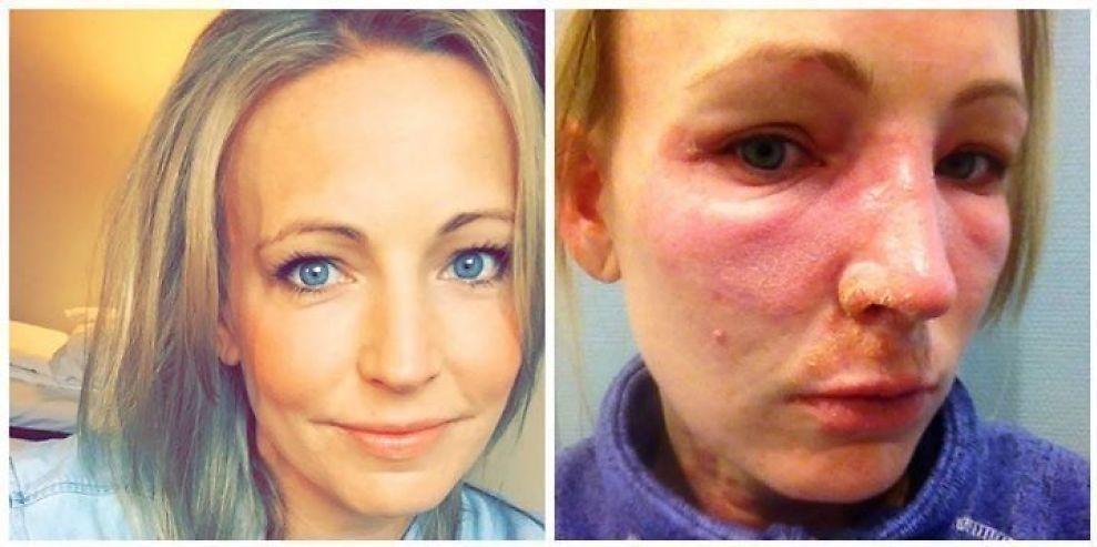ALLERGIANFALL: Birgitte VIksund utviklet kontaktallergi mot stoffet MI, og fikk en kraftig reaksjon etter at hun satte på vippeextensions tidligere i år. Foto: Privat