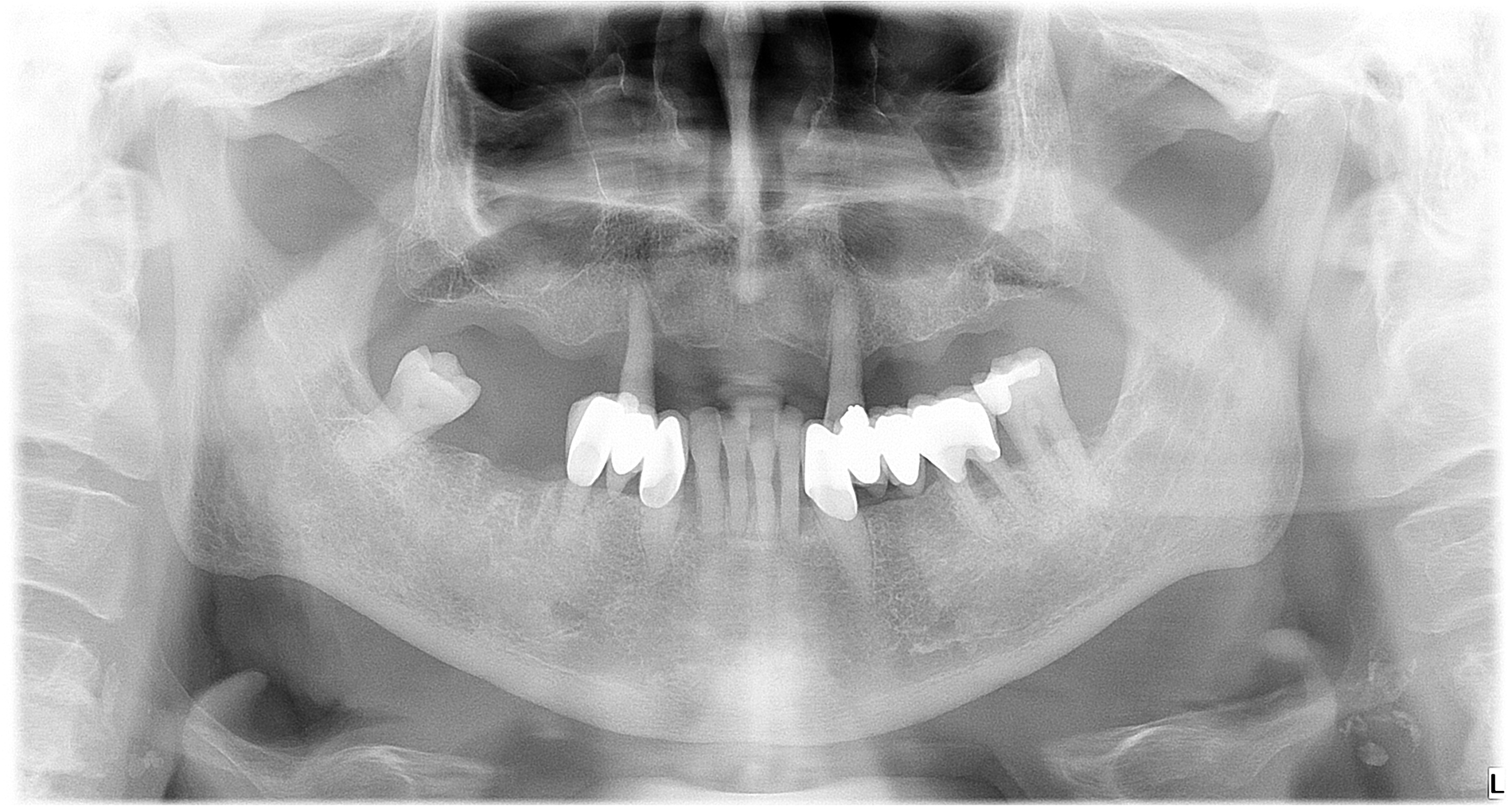 VENTET FOR LENGE: Etter flere år med tannkjøttsykdommen periodontitt, hadde Rolf (74) mistet flere tenner. Slik så røntgenbildet ut før behandlingen hos Eurodents klinikk i Budapest. FOTO: Eurodent 