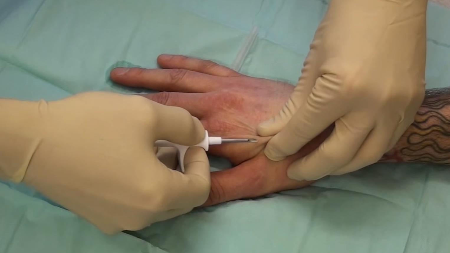 Slik så det ut da implantatet ble injisert i hånden. Foto: Patrick Lanhed/YouTube