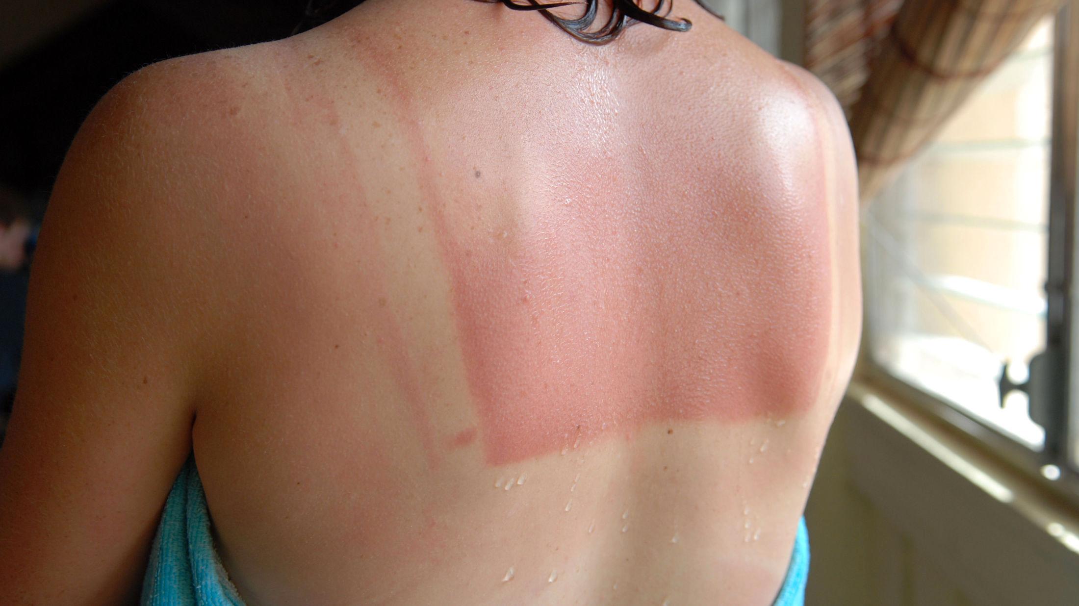 SOLBRENT: Solkremslurv kan føre til rød hud. Foto: Getty Images.